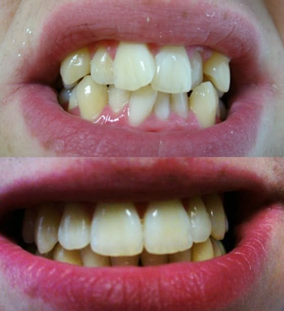 Metamorfoza uÅ›miechu pacjenta Saska Smile
