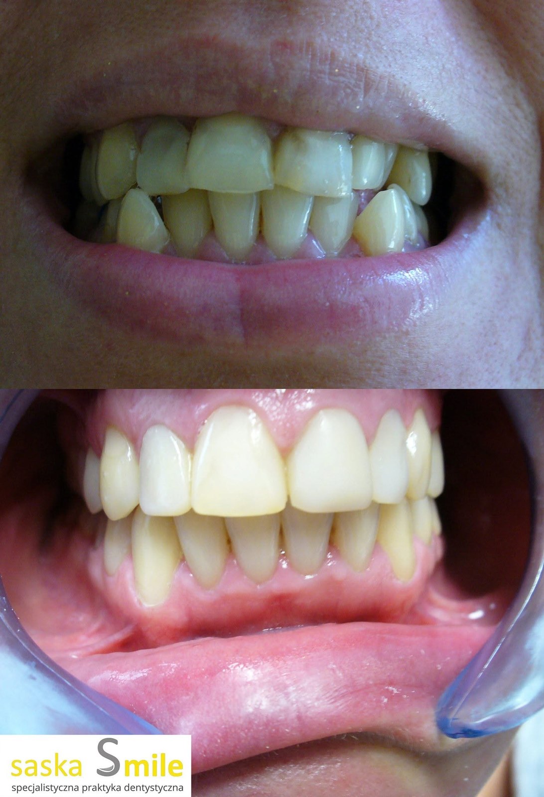 Metamorfoza uÅ›miechu pacjenta Saska Smile