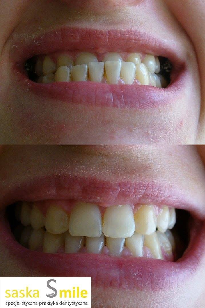 Metamorfoza uÅ›miechu pacjenta Saska Smile