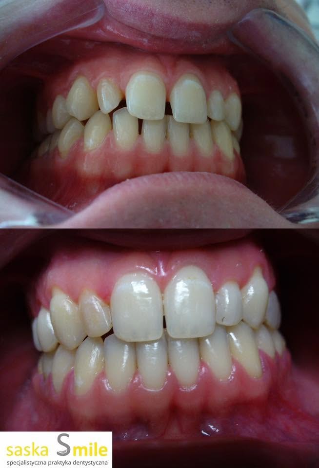 Metamorfoza uÅ›miechu pacjenta Saska Smile