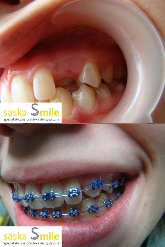 Metamorfoza uÅ›miechu pacjenta Saska Smile
