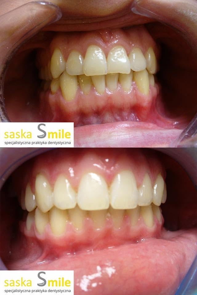 Metamorfoza uÅ›miechu pacjenta Saska Smile