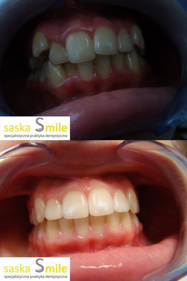 Metamorfoza uÅ›miechu pacjenta Saska Smile