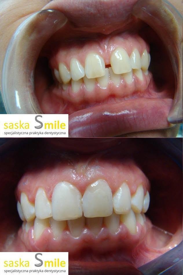 Metamorfoza uÅ›miechu pacjenta Saska Smile